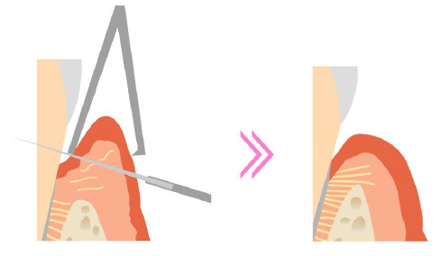 歯肉切除