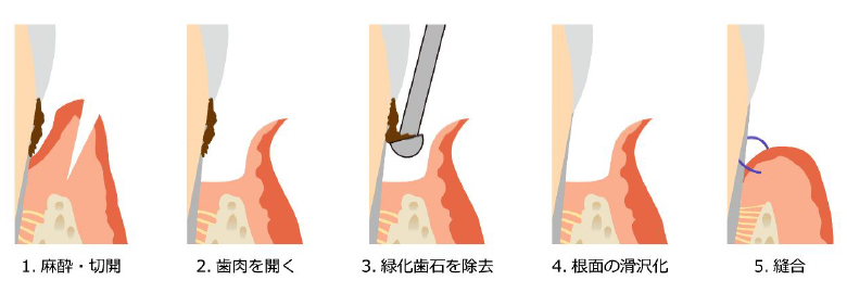 歯肉掻把術