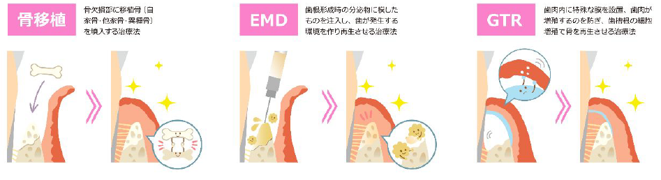 歯周組織再生療法